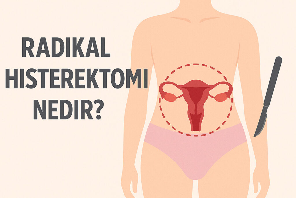 Radikal histerektomi nedir?