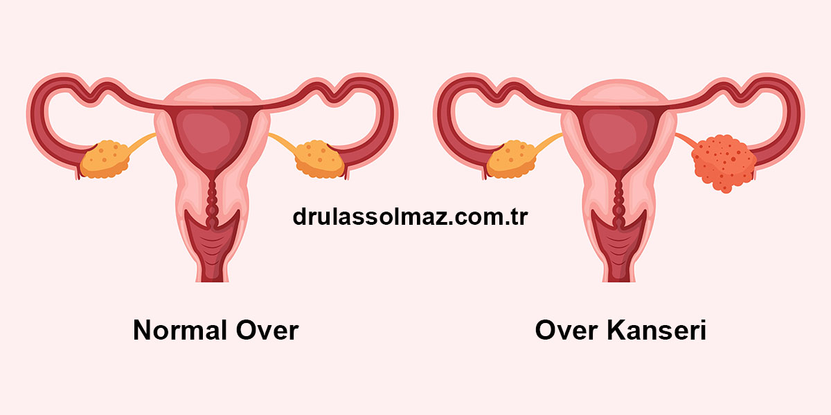 Yumurtalık (Over) Kanseri Nedir? Belirtileri ve Tedavisi