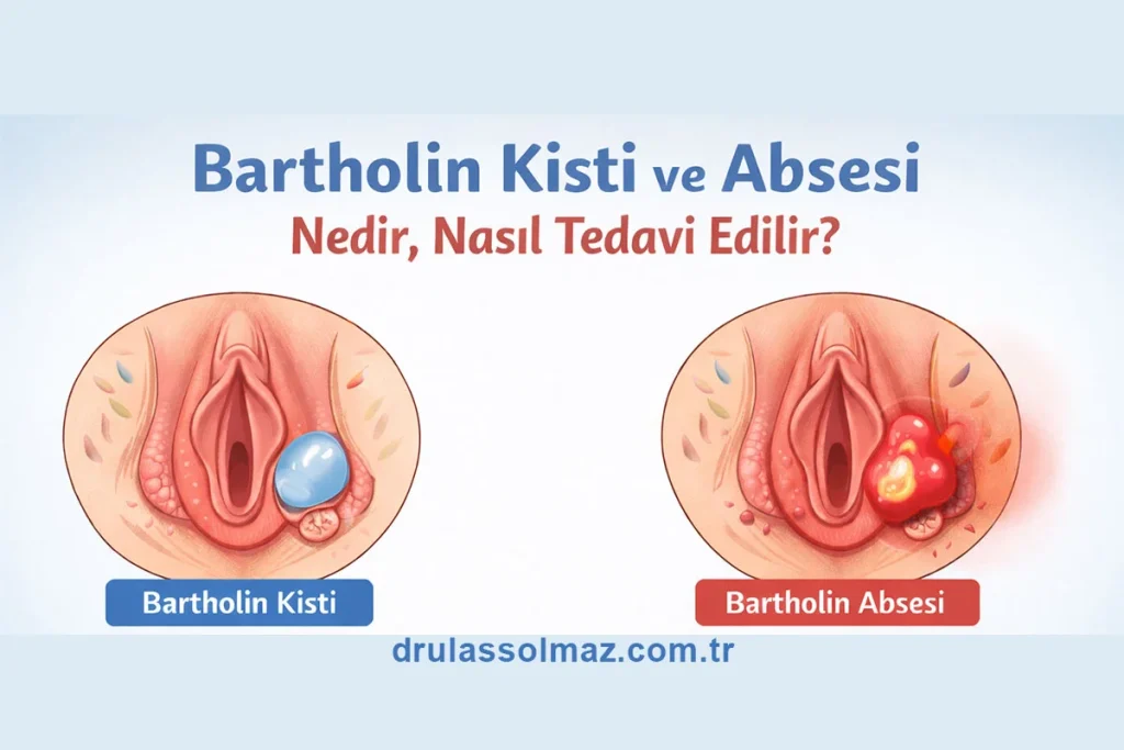 Bartholin Kisti ve Absesi Nedir, Nasıl Tedavi Edilir?